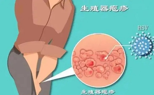 复发性生殖器疱疹如何护理 生殖器疱疹如何彻底治愈