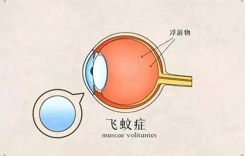 飞蚊症怎么治疗恢复 飞蚊症会导致失明吗