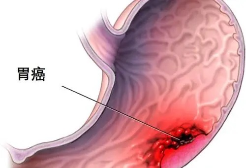 胃癌前期五个身体信号是什么 胃癌为什么叫幸运癌