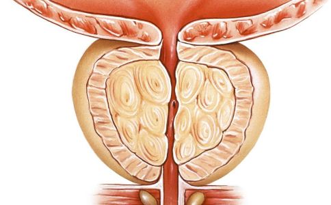 男人患前列腺炎会自己好吗 日常需要注意什么