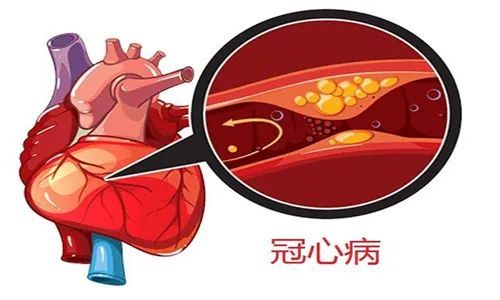 冠心病饮食禁忌有哪些 冠心病是怎样形成的