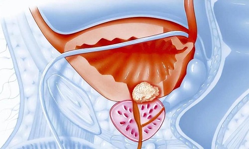 前列腺钙化怎么治疗 前列腺钙化三大危害是什么