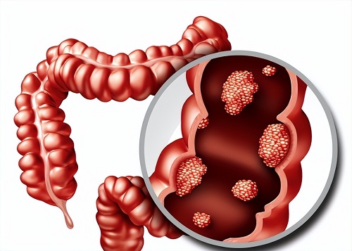 哪四种腹泻是癌症信号 什么情况下拉肚子是癌