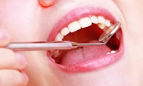 牙齿出血是什么原因 牙齿出血是缺少什么维生素