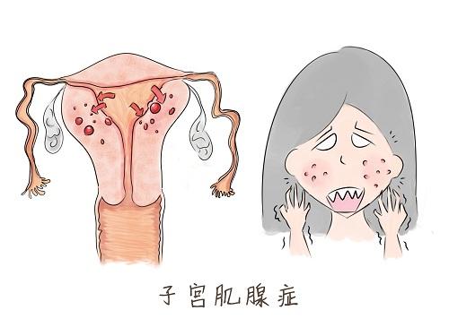 肌腺症需要手术吗 肌腺症手术后多久能怀孕