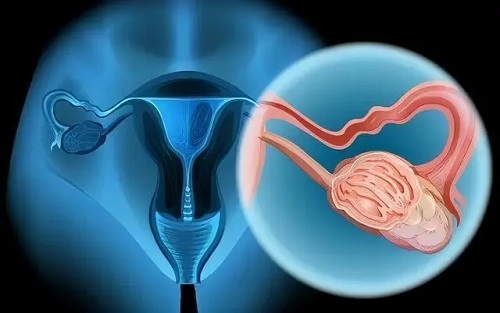 子宫肌瘤多大必须手术切除 女性为什么容易长子宫肌瘤