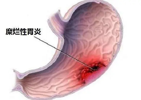 糜烂性胃炎严重吗 糜烂性胃炎的最佳治疗方法是什么