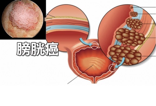 膀胱癌早期是什么症状 男人更容易有膀胱癌是什么原因