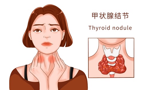 甲状腺结节能喝茶吗 甲状腺结节的形成原因是什么