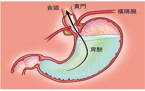 胃酸吃什么能马上缓解 胃酸过多建议吃什么食物