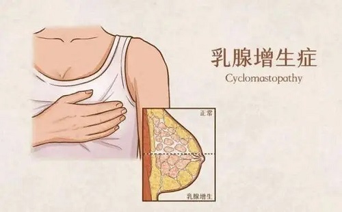 乳腺增生吃什么食物好 哪些坏习惯易致乳腺增生