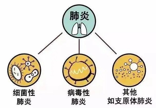 干咳是肺炎的判断标准吗 肺炎的症状和表现是什么