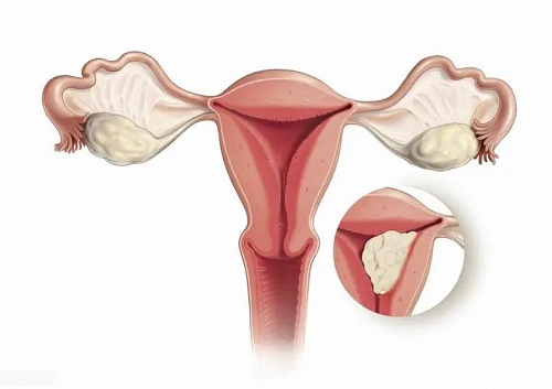 腺肌症怎么治疗能彻底好 腺肌症怎么查出来的
