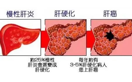 肝硬化传染吗 肝癌为什么是穷人癌