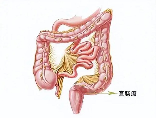 结肠癌术后能活多久 结肠癌手术后遗症有哪些